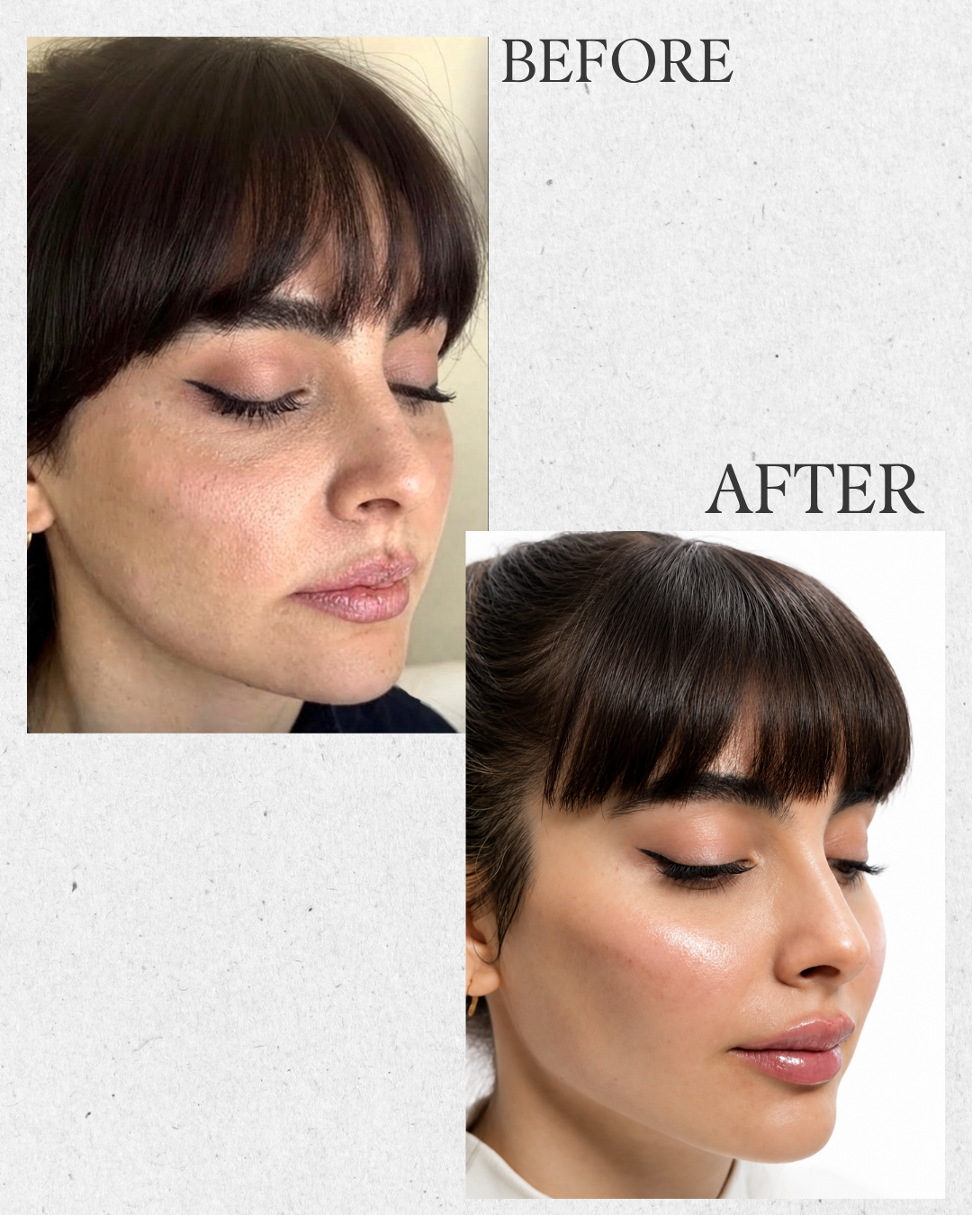 Before and after facial contouring results